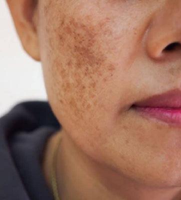 How to treat Melasma at home? - AMINU